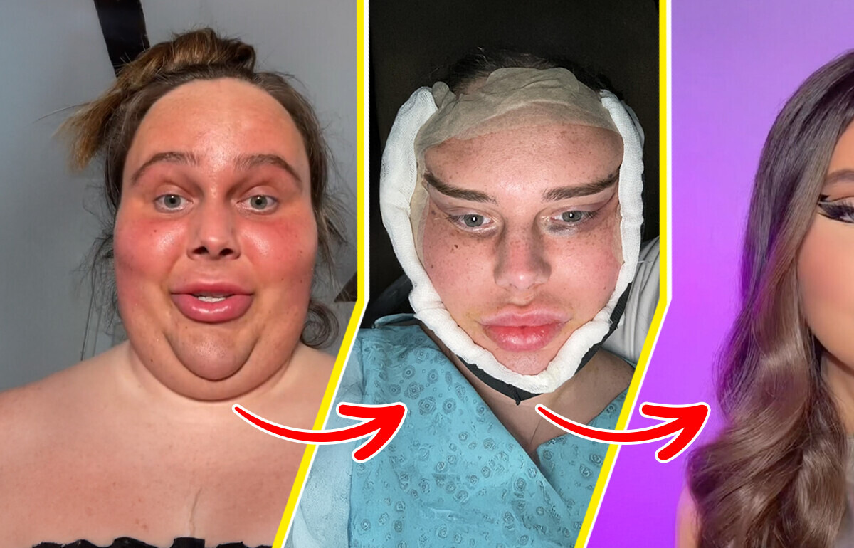 Une influenceuse choque par sa métamorphose suite à une opération de chirurgie esthétique Une influenceuse choque par sa métamorphose suite à une opération de chirurgie esthétique