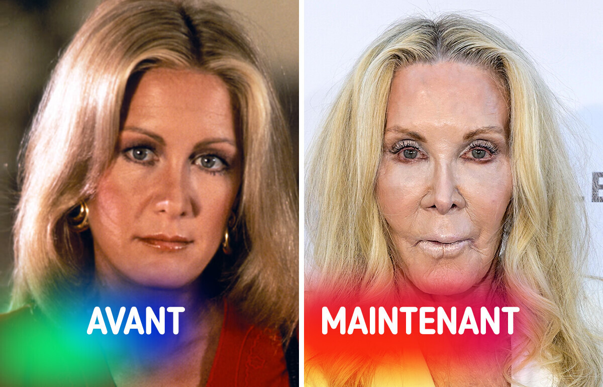 13 Célébrités que la chirurgie esthétique a totalement transformées 13 Célébrités que la chirurgie esthétique a totalement transformées