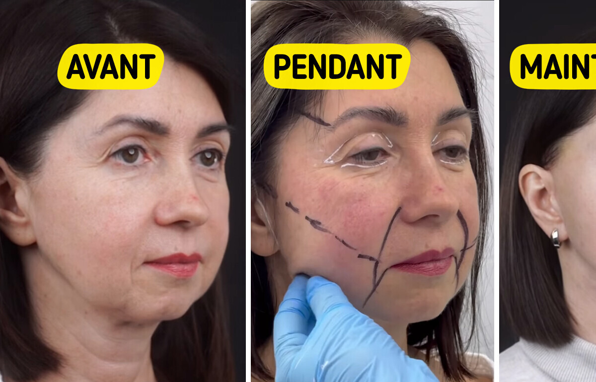 Une femme de 49 ans révèle les résultats spectaculaires de sa chirurgie de rajeunissement Une femme de 49 ans révèle les résultats spectaculaires de sa chirurgie de rajeunissement