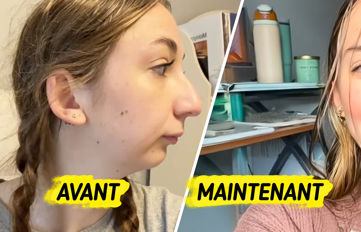 Une jeune femme subit une opération complexe de la mâchoire et stupéfie la toile par son changement Une jeune femme subit une opération complexe de la mâchoire et stupéfie la toile par son changement