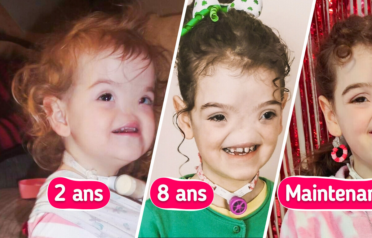 Un bébé né sans nez, surnommé “Voldemort”, redéfinit aujourd’hui la beauté Un bébé né sans nez, surnommé “Voldemort”, redéfinit aujourd’hui la beauté