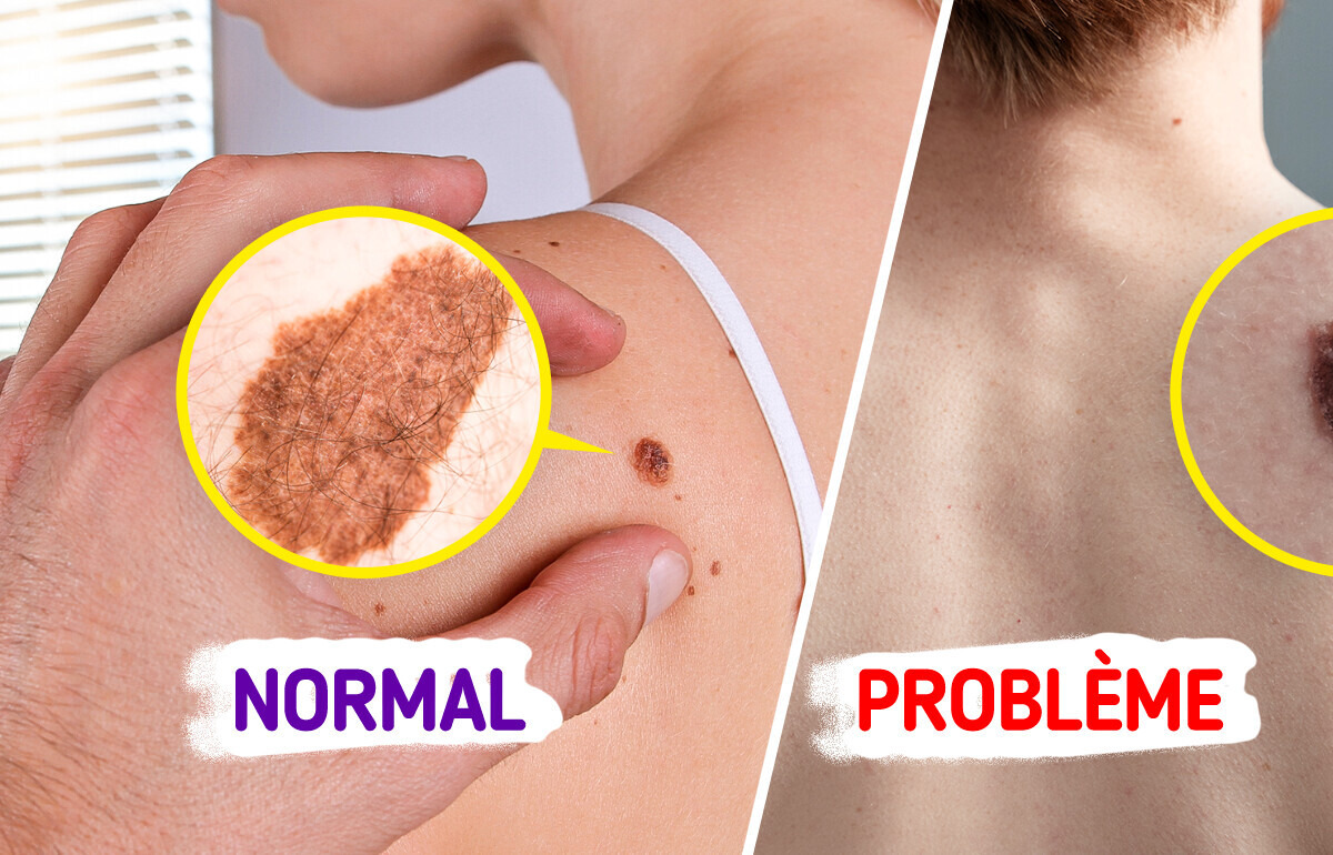5 Signes d’alarme qui indiquent que tes grains de beauté cachent peut-être un cancer de la peau 5 Signes d’alarme qui indiquent que tes grains de beauté cachent peut-être un cancer de la peau