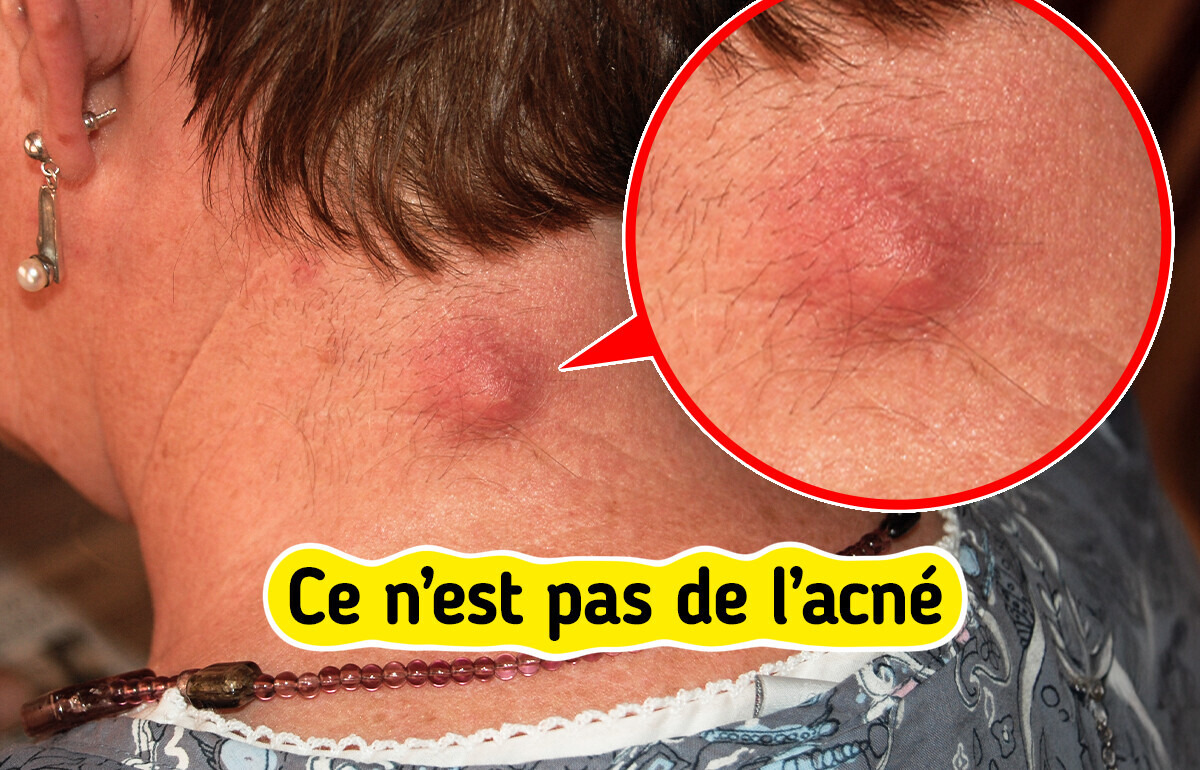 7 Bosses sur la peau que tu confonds peut-être avec de l’acné