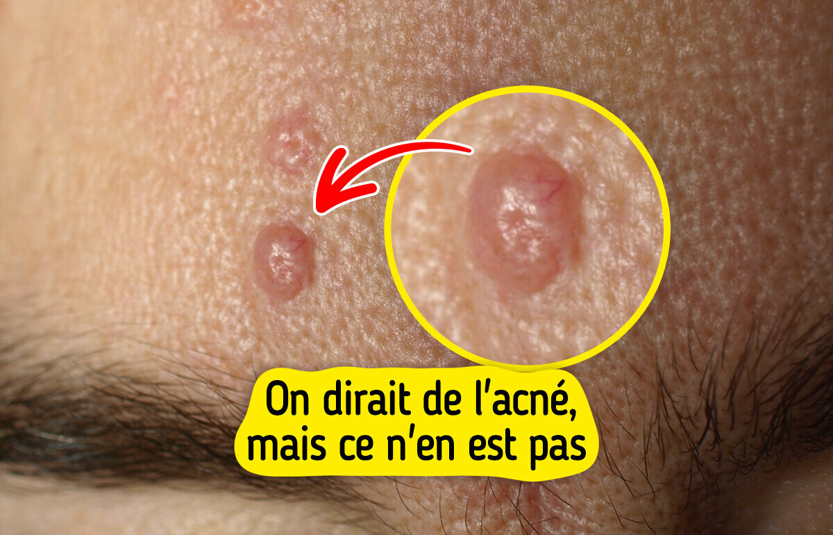 7 Sortes de boutons qui ressemblent à s’y méprendre à de l’acné, mais qui n’en sont pas