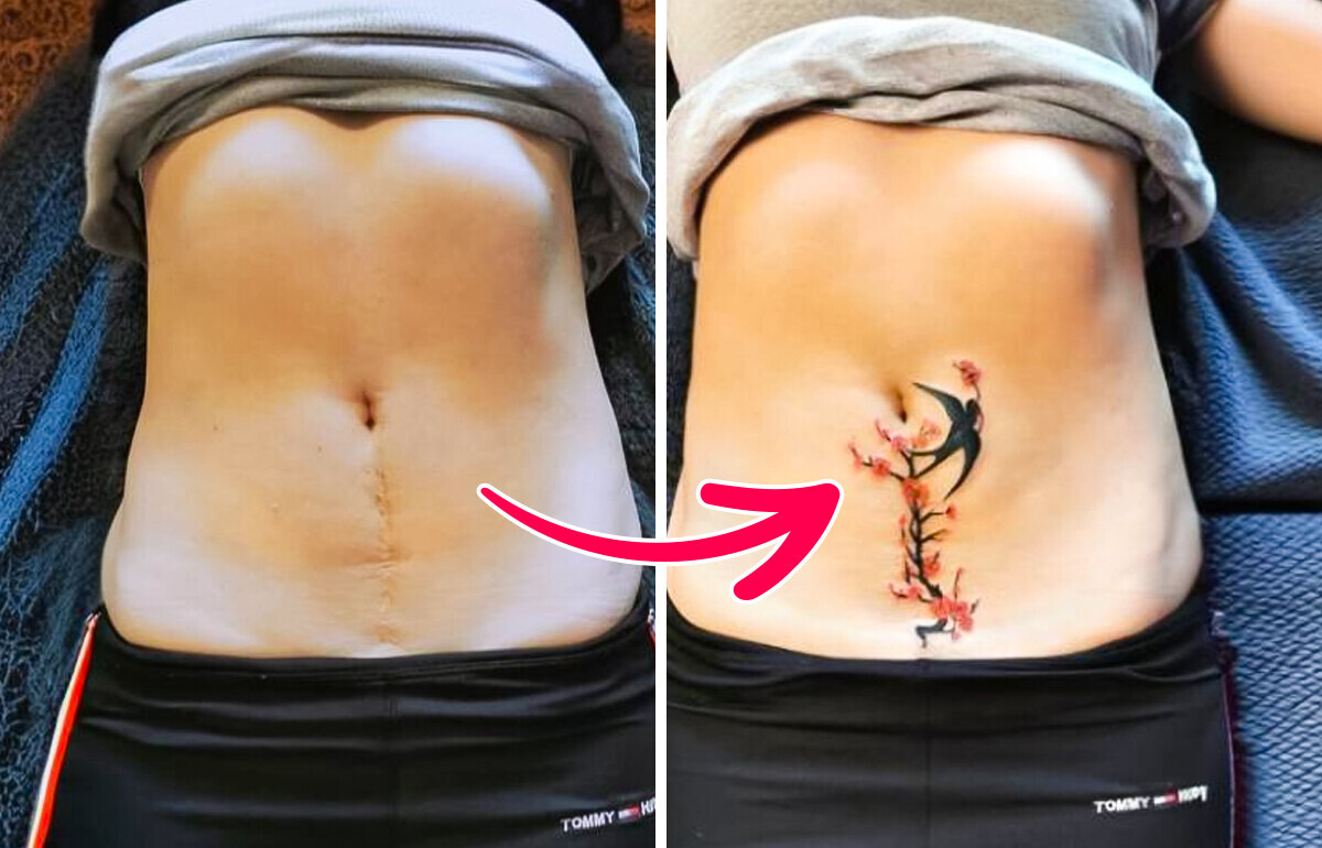 16 Tatoueurs qui ont donné une seconde vie à des cicatrices 16 Tatoueurs qui ont donné une seconde vie à des cicatrices
