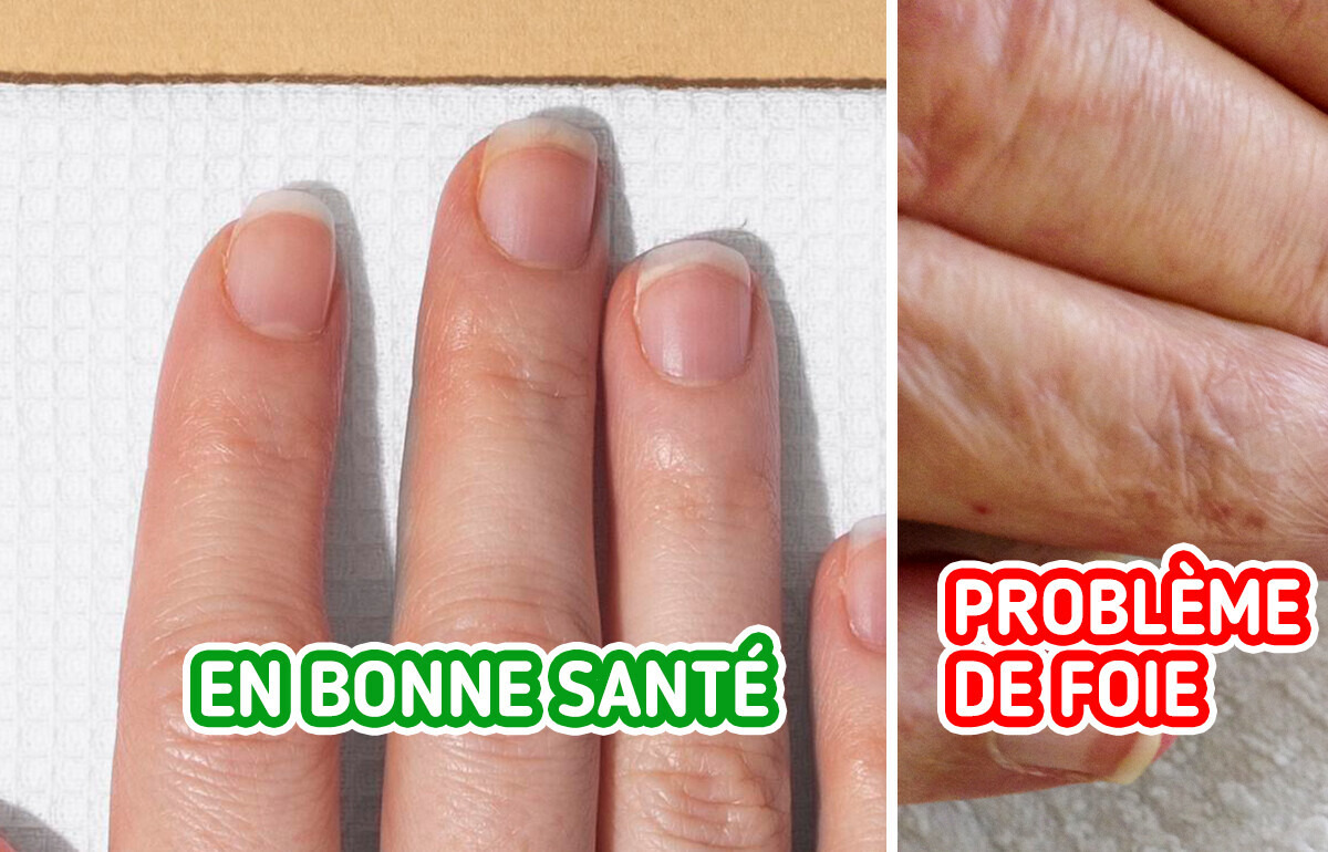 6 Signes qui prouvent que ton foie ne va pas bien