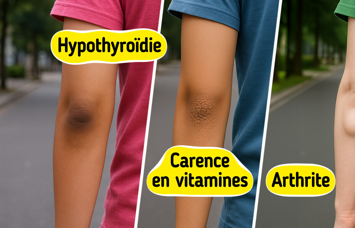 10 Signes visibles sur tes coudes qui peuvent indiquer un problème de santé 10 Signes visibles sur tes coudes qui peuvent indiquer un problème de santé