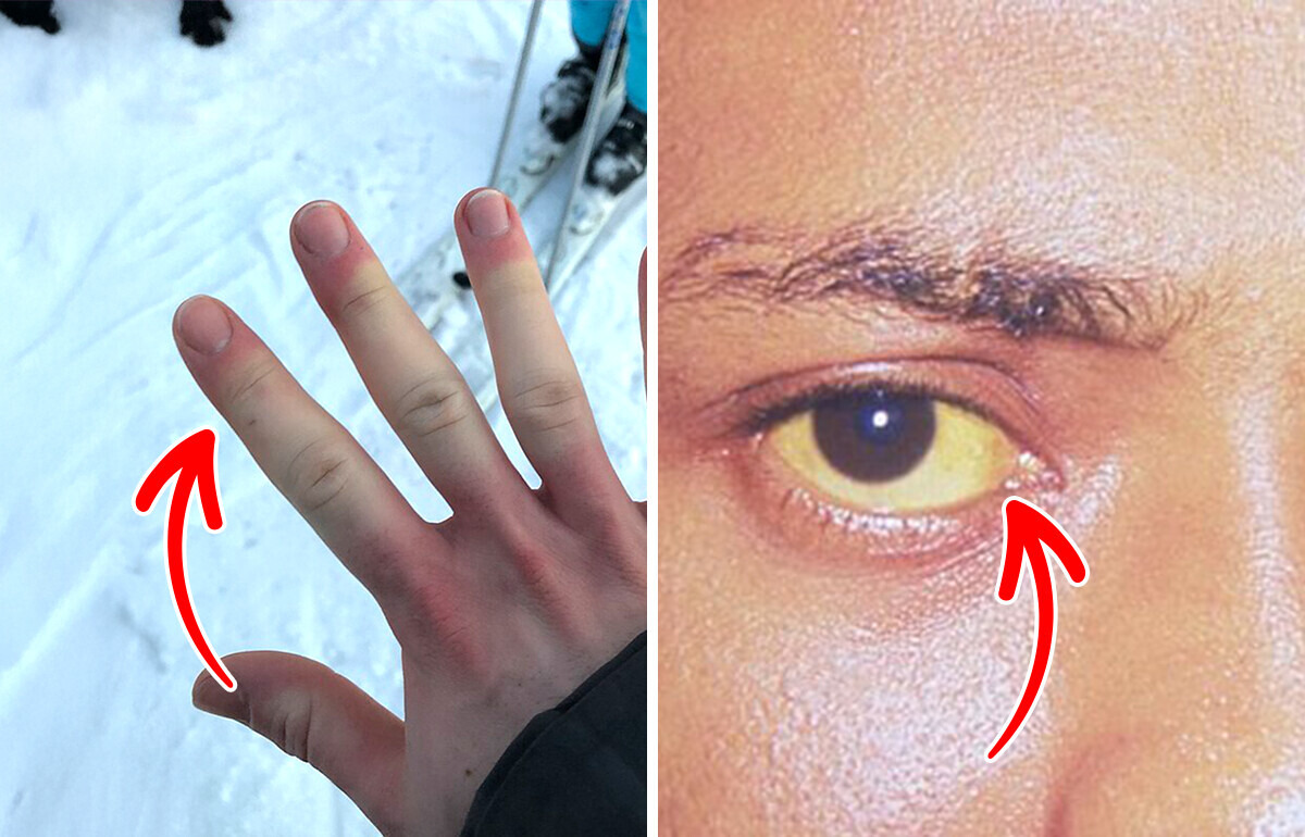 8 Signes que ta santé immunitaire tire la sonnette d’alarme