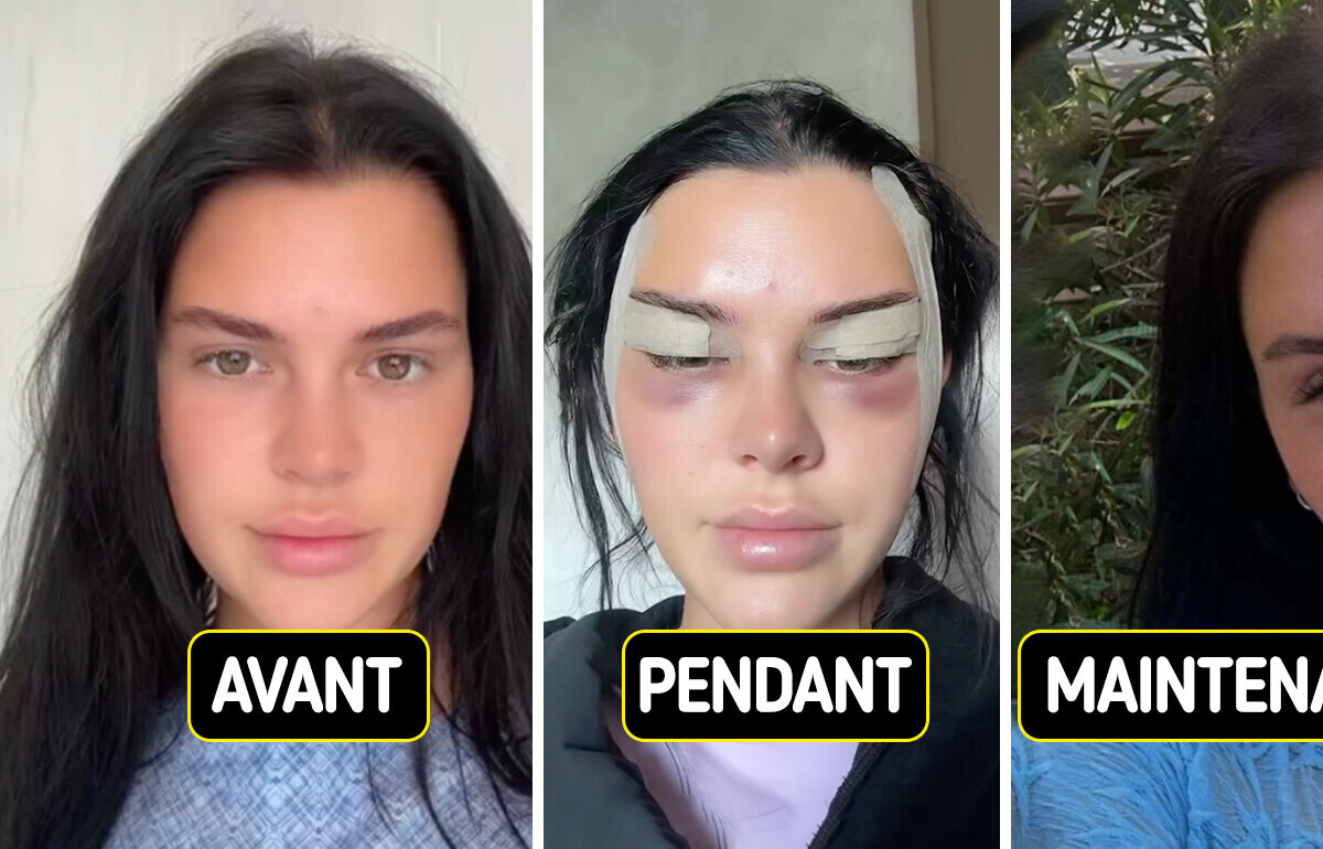 Cette jeune femme partage sa chirurgie “fox eyes”, et les résultats laissent tout le monde sous le choc