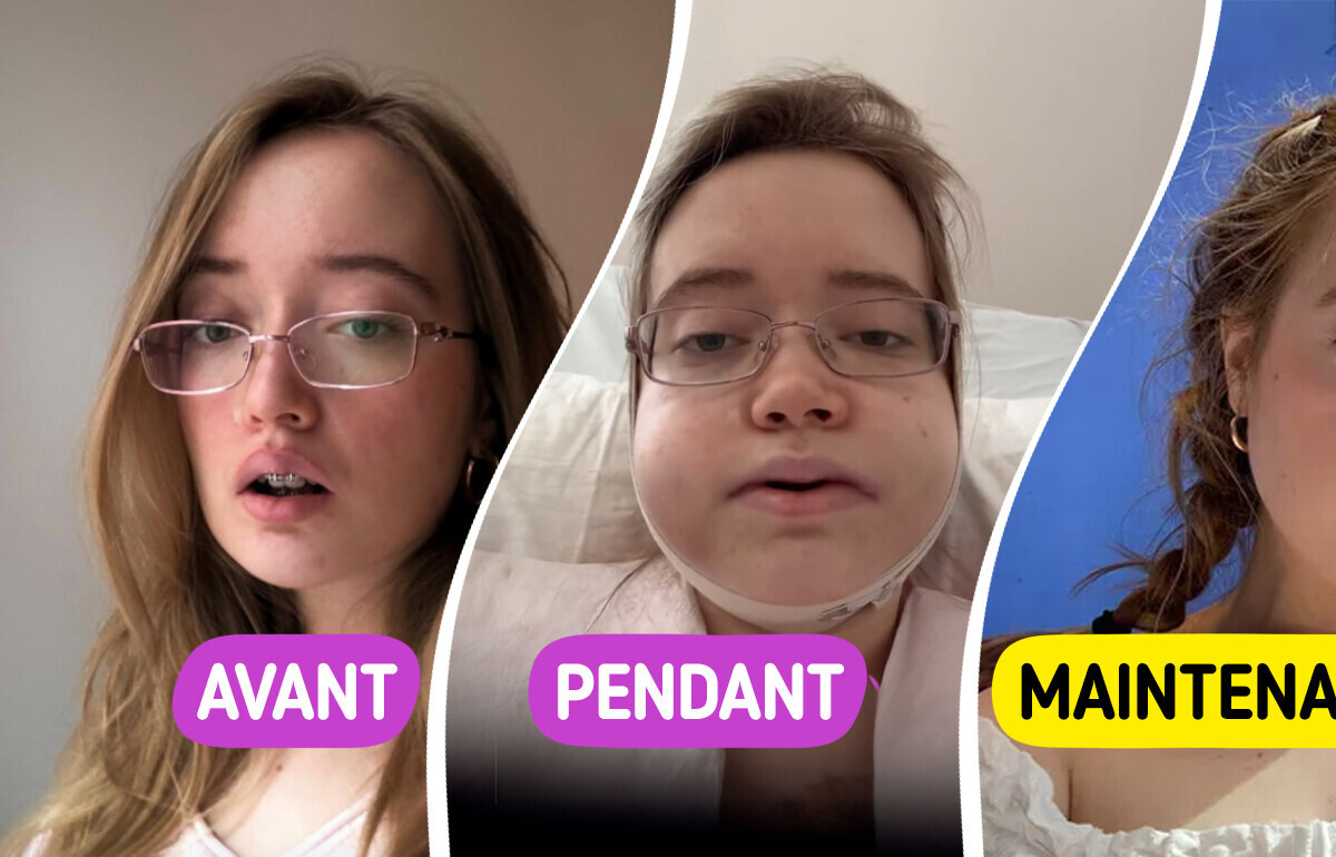 Une chanteuse documente son opération de la mâchoire, et le résultat laisse tout le monde sans voix Une chanteuse documente son opération de la mâchoire, et le résultat laisse tout le monde sans voix