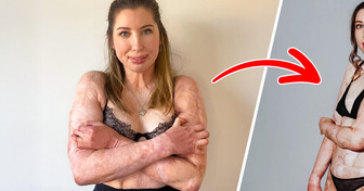 Une femme, brûlée vive à 96 %, rayonne aujourd’hui en bikini et défie les normes de beauté