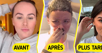 Cette femme complexée par la taille de son front a décidé d’y remédier par la chirurgie esthétique