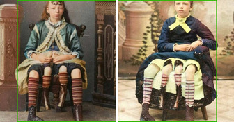 Née avec quatre jambes, elle a prouvé qu’une différence pouvait devenir une force