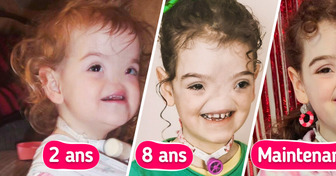 Un bébé né sans nez, surnommé “Voldemort”, redéfinit aujourd’hui la beauté