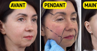 Une femme de 49 ans révèle les résultats spectaculaires de sa chirurgie de rajeunissement