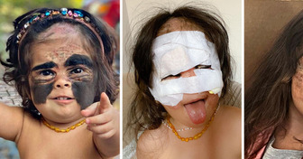 Une fillette moquée pour sa tache de naissance retrouve le sourire grâce à sa maman