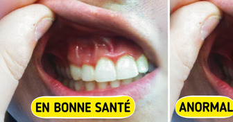 5 Choses que tes gencives essaient de te dire sur ta santé