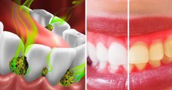 6 façons de tuer les bactéries de la bouche et d’en finir avec la mauvaise haleine