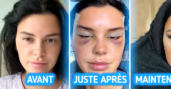 Une jeune femme crée la polémique suite à une opération des yeux