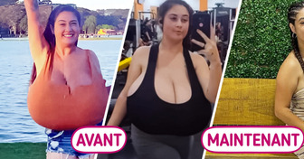 Une jeune femme se fait opérer pour réduire sa poitrine de 10 kilos : le quotidien difficile de la gigantomastie