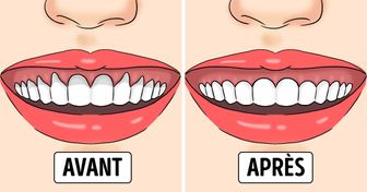 Si tu as les dents déchaussées ou des gencives abîmées, voici quelques solutions efficaces