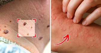6 Symptômes sournois du diabète que tu pourrais ne pas remarquer