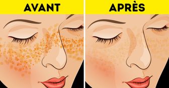 Voici 7 conseils d’autrefois pour te débarrasser des cicatrices de l’acné et des imperfections de la peau