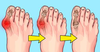 8 Méthodes pour soulager naturellement les douleurs provoquées par les oignons aux pieds