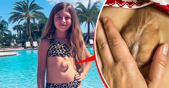 Cette jeune fille est née avec le cœur à l’extérieur de la poitrine, défiant les médecins qui ne lui donnaient aucune chance de vivre