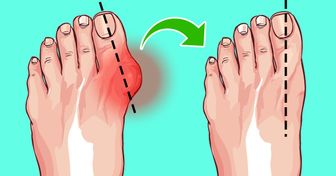 6 Manières simples de réduire tes oignons aux pieds sans avoir recours à la chirurgie