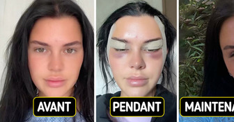 Cette jeune femme partage sa chirurgie “fox eyes”, et les résultats laissent tout le monde sous le choc
