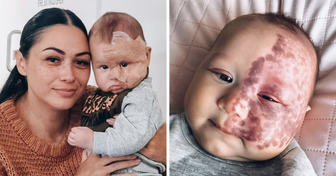 Une maman a fait enlever une tache de naissance sur le visage de son bébé et elle dévoile ses raisons