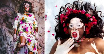 Une femme atteinte de vitiligo raconte comment elle est parvenue à s’accepter et à devenir mannequin