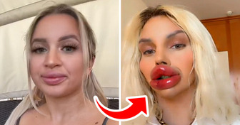 Des lèvres XXL : Cette femme révèle l’impact choquant de ses opérations sur sa vie quotidienne