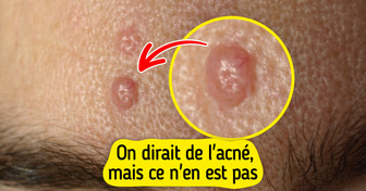 7 Sortes de boutons qui ressemblent à s’y méprendre à de l’acné, mais qui n’en sont pas