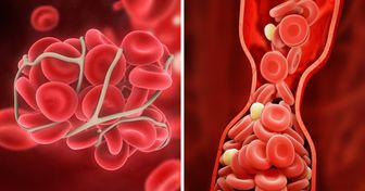 10 Façons de prévenir les caillots de sang qui pourraient te sauver la vie