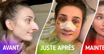 Une femme partage les résultats de sa chirurgie plastique, et la transformation laisse tout le monde pantois