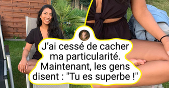 13 Personnes qui ont des particularités physiques impossibles à reproduire