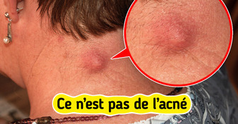 7 Bosses sur la peau que tu confonds peut-être avec de l’acné