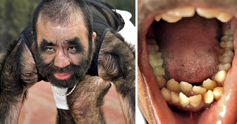 10 Cas de caractéristiques physiques extraordinaires dont on douterait presque de l’existence