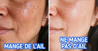 Les causes de la pigmentation de la peau et 4 façons de l’éviter