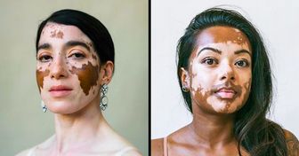 Une photographe met en avant la beauté des femmes atteintes de vitiligo