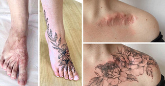 15 Cicatrices qui sont devenues des symboles de beauté et de force