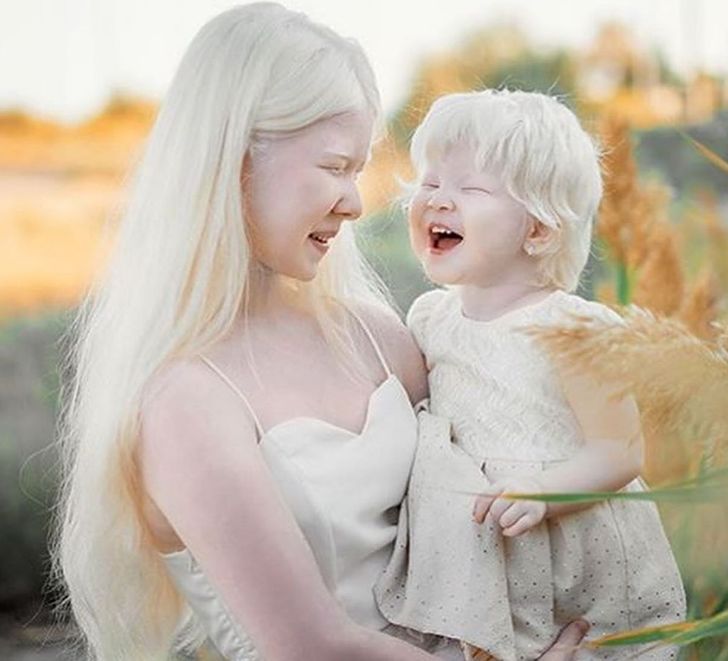 Deux sœurs albinos nées à 12 ans d’intervalle agitent la toile avec leurs photos